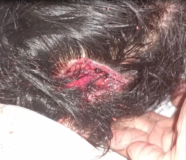 תמונת הפצע בראש של החטופה נועה מרציאנו להוכחת הטענה שנפצעה מפצצה של צהל