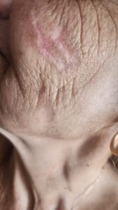 דנה רביבו קוסמטיקאית תוצאות כוויות בלחי