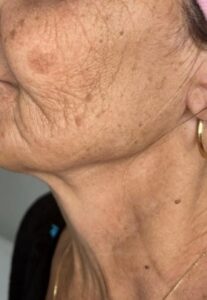 טיפולי דנה רביבו - הלפני- תמונה לפני הכויות שעשתה